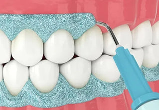 Maarc Blitz White Bleaching Kit Buy Dental products Online DentalMyntra