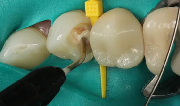 Prevest ApaCal ART Buy Dental products Online DentalMyntra