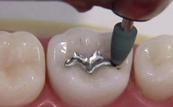 Shofu Amalgam Polishing Kit Fg/Ca Buy Dental products Online DentalMyntra