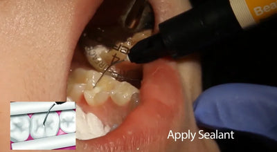 Shofu BeautiSealant Pit & Fissure Sealant Buy Dental products Online DentalMyntra