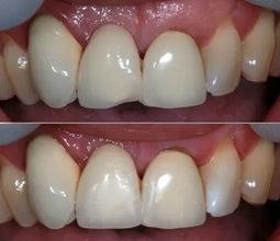 Shofu P & R Repair Kit Buy Dental products Online DentalMyntra