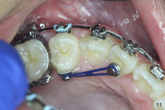 Orthodontic lingual buttons Bondable mesh base