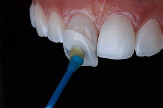 Smart Dental Veneer Stick Set of 20 | Veneer Placement 