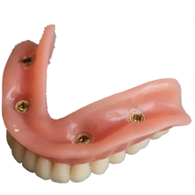 Implant Model with Bar – Dental Training Model