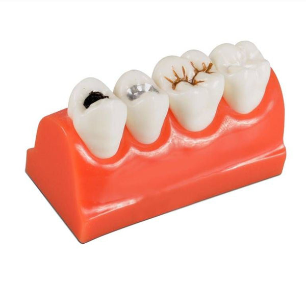 OCTA SEALANT & CARIES MODEL