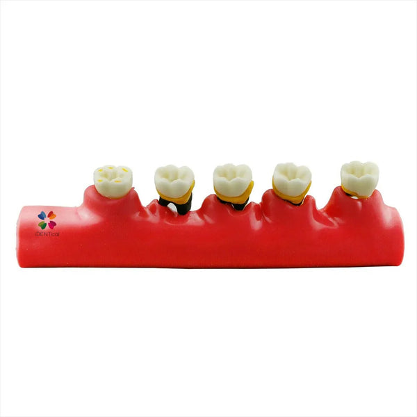 Stages Of Periodontitis Model - M4010