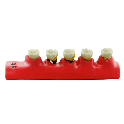 Stages Of Periodontitis Model - M4010