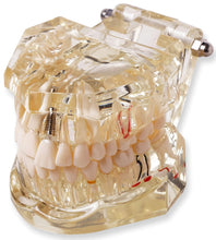 Implant Model with Bar – Dental Training Model 
