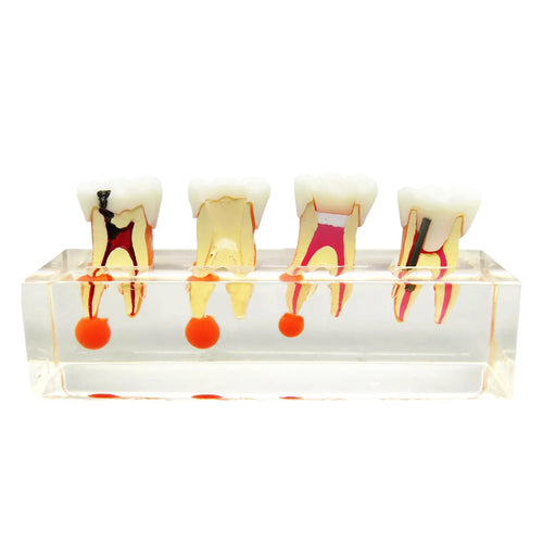 DENTical Study Model Root Canal Treatment M 4018
