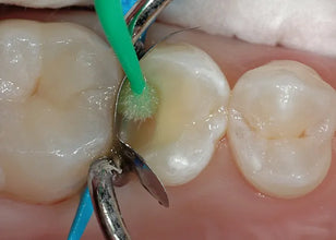 FUSION BOND 7 Buy Dental products Online DentalMyntra