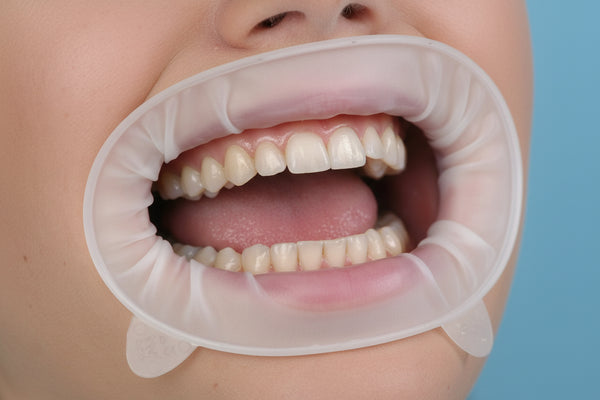 Ivoclar OptraGate Lip & Cheek Retractor | Latex-Free Dental Isolator ...