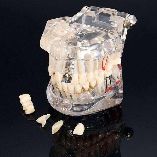 ALL IN ONE IMPLANT MODEL