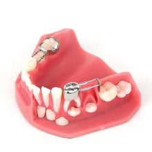Kids-e-Dental Space Maintainer Band Refills Buy Dental products Online DentalMyntra