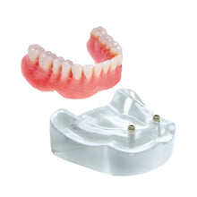2 Implant Model