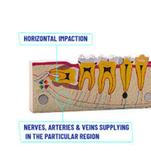 OCTA THIRD MOLAR IMPACTION TEETH MODEL