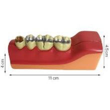 OCTA THIRD MOLAR IMPACTION TEETH MODEL