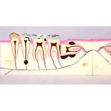OCTA THIRD MOLAR IMPACTION TEETH MODEL