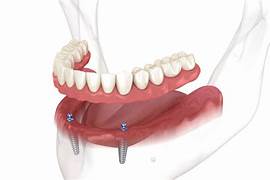 2 Implant Model