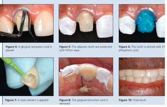 Prevest Fusion Self Lute Buy Dental products Online DentalMyntra