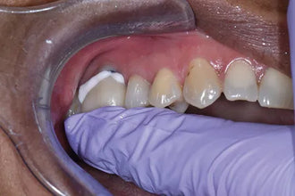 Prevest Fusion Self Lute Buy Dental products Online DentalMyntra