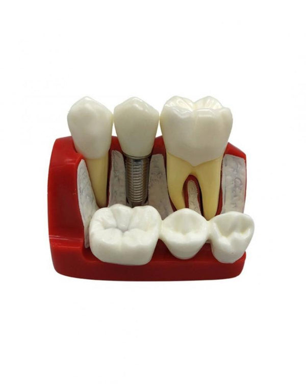 OCTA IMPLANT ANALYSIS BRIDGE MODEL