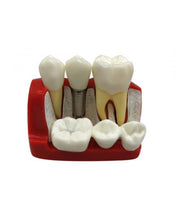 Octa Implant Analysis Bridge Model – Dental Training 