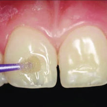 Prevest Renew Universal Dental Adhesive Regular Pack