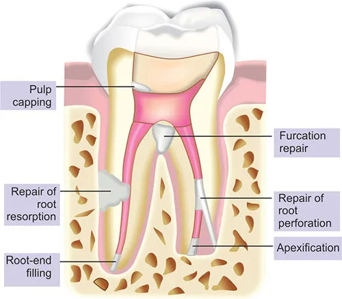 SafeEndo BioStructure MTA Buy Dental products Online DentalMyntra