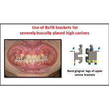 MBT Metal Bracket  BaTR- Brackets with Variable Torque and Rotation