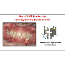 MBT Metal Bracket  BaTR- Brackets with Variable Torque and Rotation