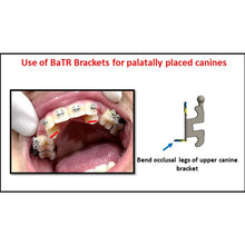 MBT Metal Bracket  BaTR- Brackets with Variable Torque and Rotation