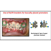 MBT Metal Bracket  BaTR- Brackets with Variable Torque and Rotation