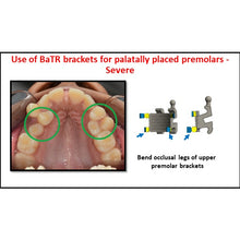 MBT Metal Bracket  BaTR- Brackets with Variable Torque and Rotation