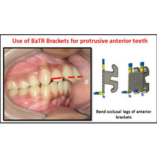 MBT Metal Bracket  BaTR- Brackets with Variable Torque and Rotation
