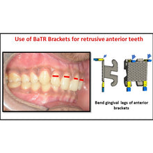 MBT Metal Bracket  BaTR- Brackets with Variable Torque and Rotation