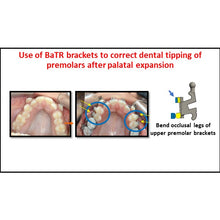 MBT Metal Bracket  BaTR- Brackets with Variable Torque and Rotation