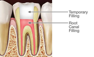 SmartTemp Temporary Dental Filling –