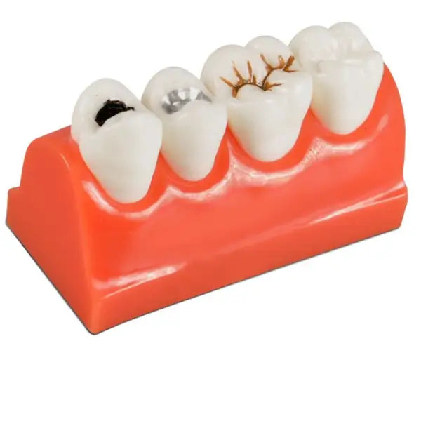 Caries Model