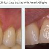 VOCO Amaris Gingiva – Set & Refill Buy Dental products Online DentalMyntra