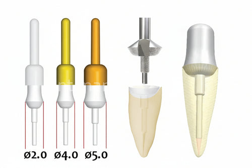 Fiber Site Post Refills Pack of 10 | Fiberglass Dental Post