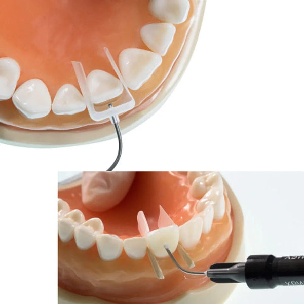 IVeneer Injectable Composite for Aesthetic Restorations