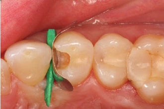 Wooden Wedges for Precise Dental Restorative Procedures