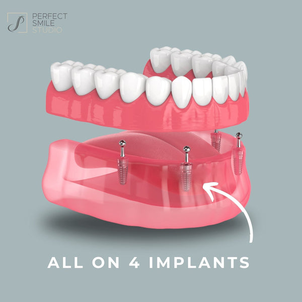4 Implant Dental Training Jaw Model for Implant Practice