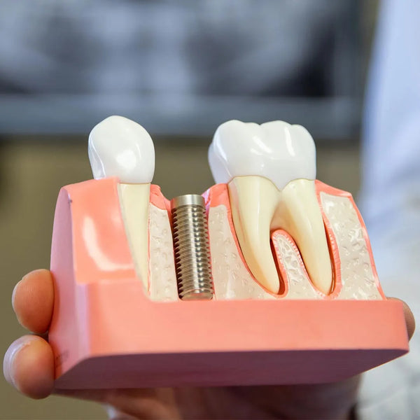 Octa Implant Analysis Bridge Model – Dental Study & Training Model