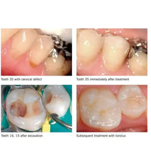SafeEndo ReCreate Bond 5 | 5th Gen Dental Bonding 
