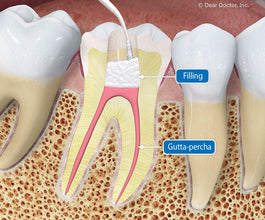 Medicept Bio Fill Root Canal Filling Material