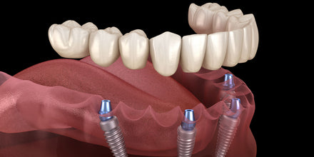 4 Implant Model