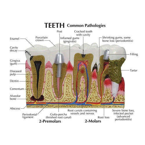 iDENTical Diseased Teeth and Gums Model M4029