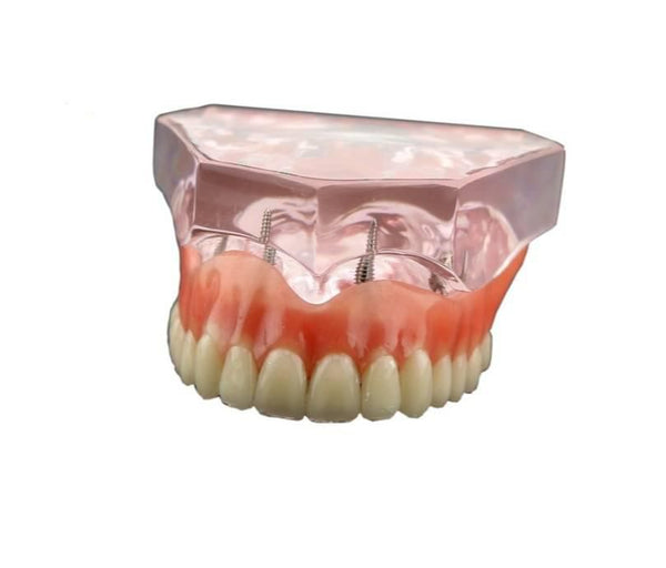 OCTA UPPER OVERDENTURE MAXILLA WITH 4 IMPLANTS