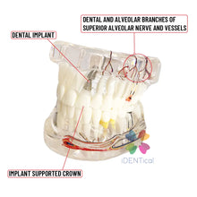 iDENTical Patient Education Model (Caries,implant,Nerves) M2001-3 Buy Dental products Online DentalMyntra